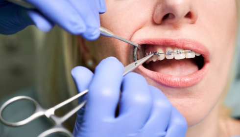 Braces Treatment Journey: From First Consultation to Retainers Explained