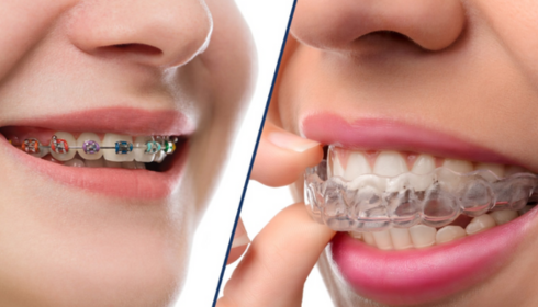 Clear Aligners vs Traditional Braces: Lifestyle, Comfort and Results Compared