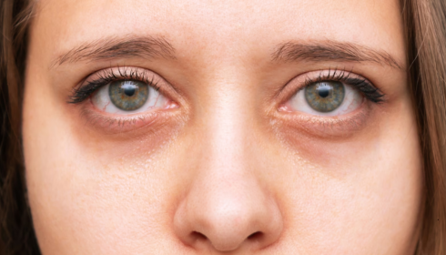 Dark Circles Under Eyes: Common Everyday Causes and Simple Care Tips