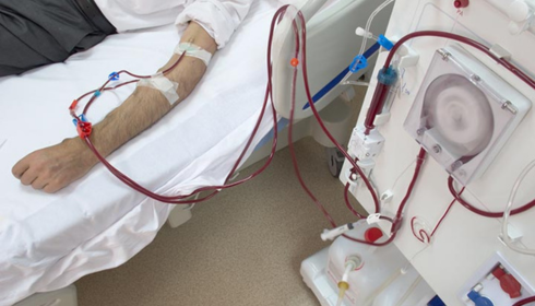 Dialysis in Simple Words: Why It’s Done and What a Session Looks Like
