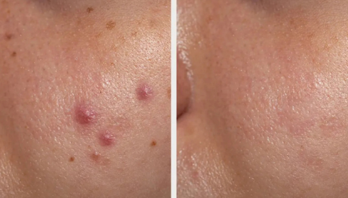 Acne Scars vs Active Pimples: Why Treatment Plans Are Different for Each