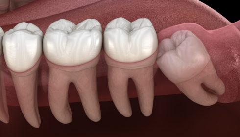 Wisdom Teeth Removal: When Waiting Is Okay and When Extraction Is Better